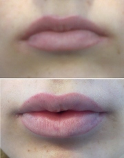 Увеличение губ,  заполнение морщин и носогубных складок